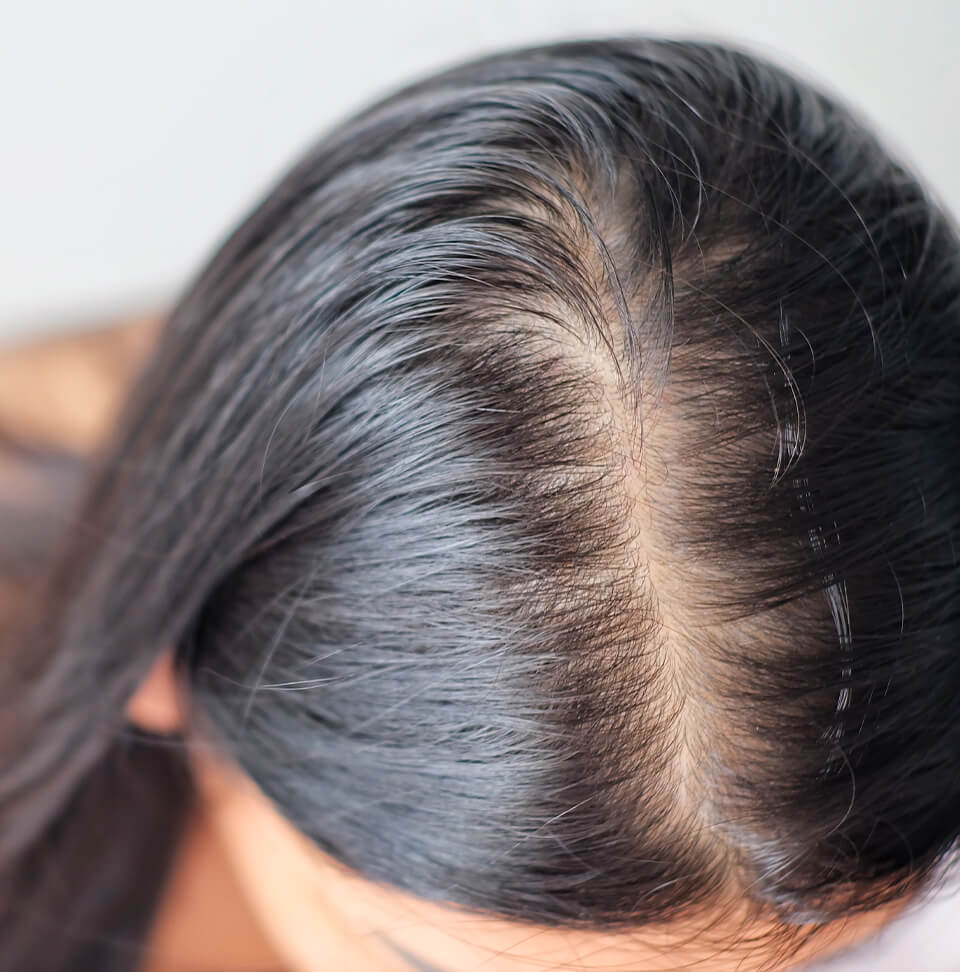 Come contrastare gli inestetismi dell'alopecia
