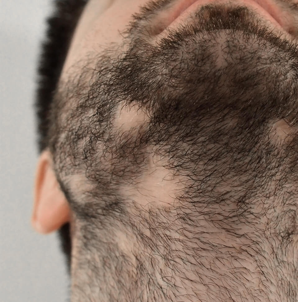 Alopecia della barba