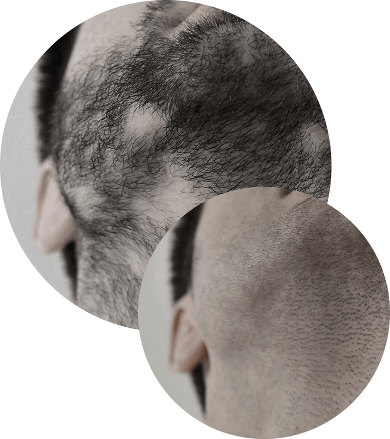 Tricopigmentazione infoltimento barba