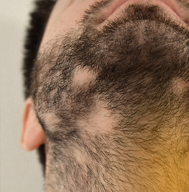 Infoltimento Barba