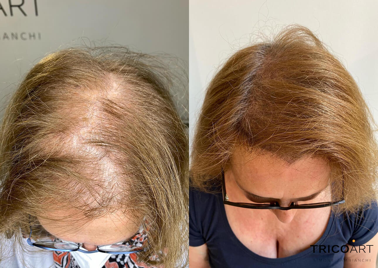 Rimedi per la Perdita dei Capelli Como