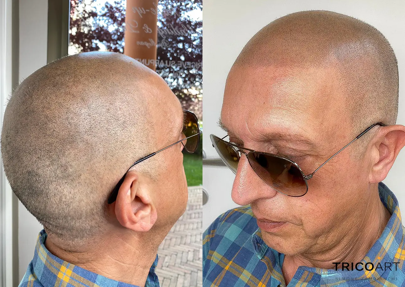 RIMEDI PER LA PERDITA DEI CAPELLI PADOVA