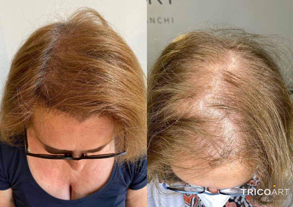 Tricopigmentazione: rimedio per alopecia e calvizia