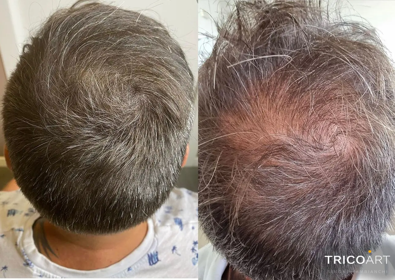 Sconfiggere l'Alopecia a Prato: Scopri la Tricopigmentazione