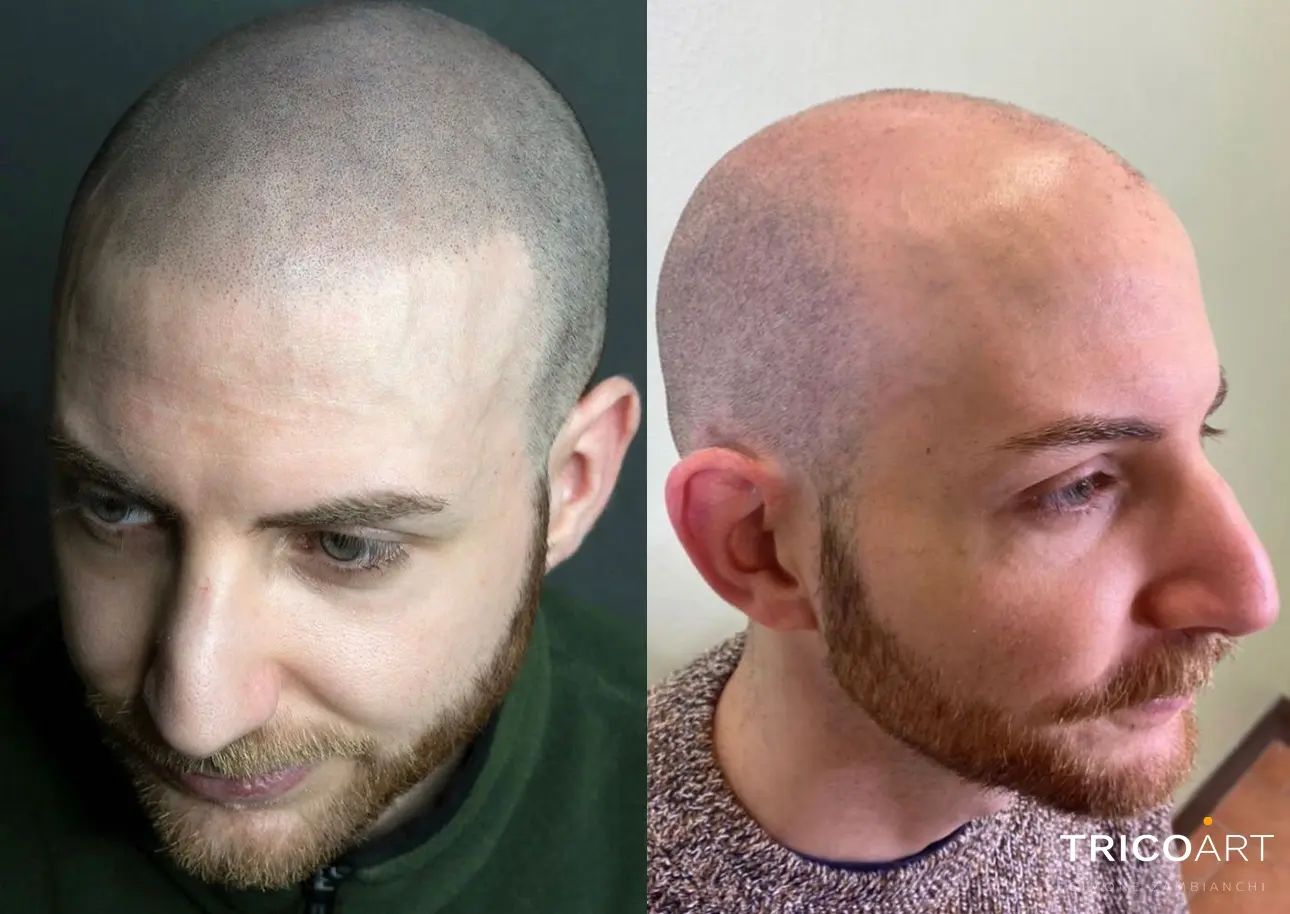 Sconfiggere l'Alopecia a Livorno: Scopri la Tricopigmentazione