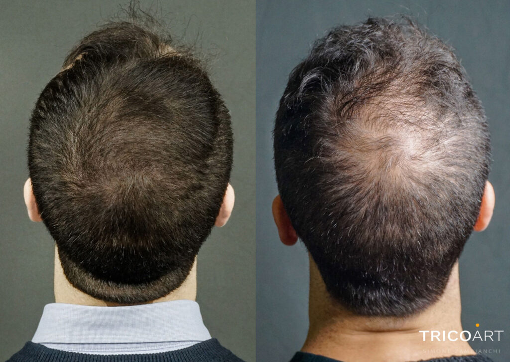Cura per l'alopecia a Padova