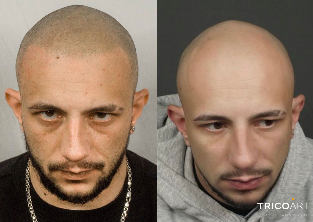 RIMEDI ALL'ALOPECIA ROMA
