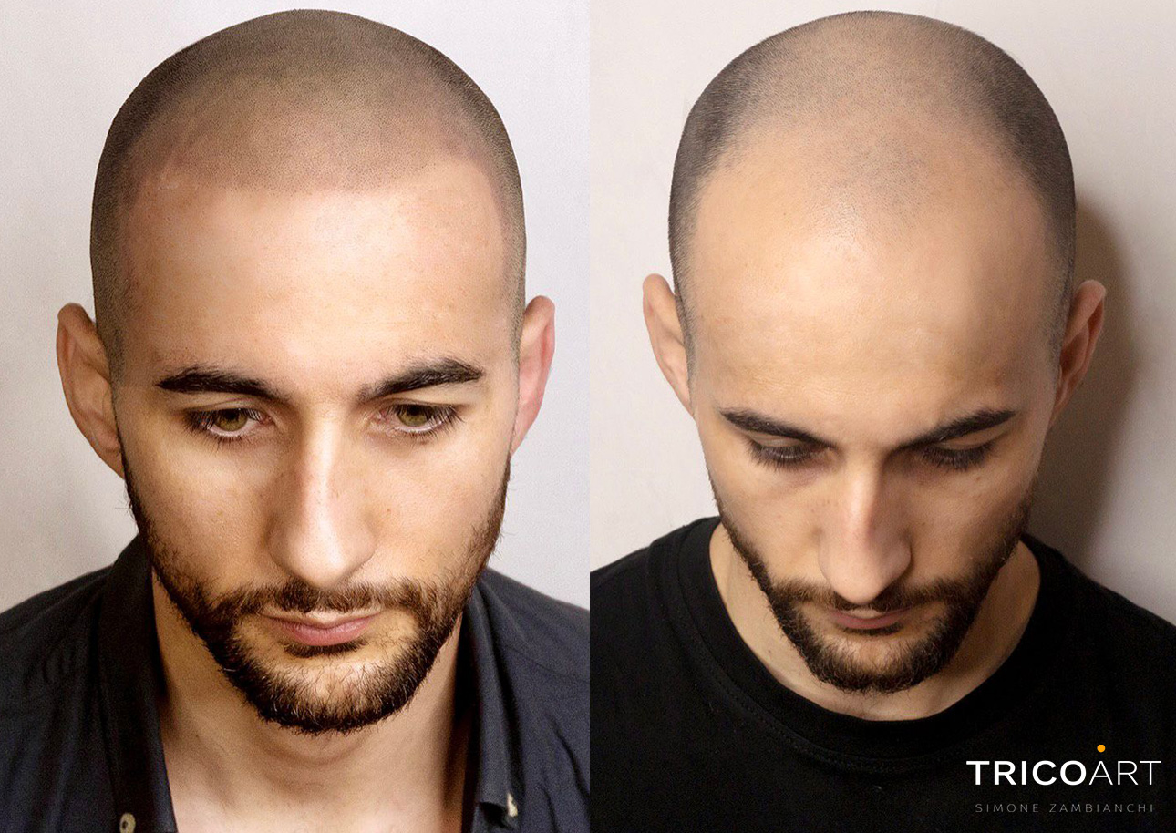 Metodi di Ricrescita Capelli Varese