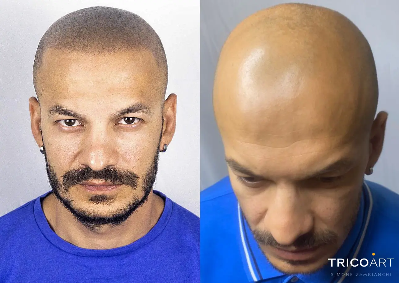 SOLUZIONE ALLA CADUTA DEI CAPELLI ROMA