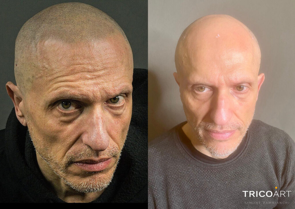 Tricopigmentazione: rimedio per alopecia e calvizia