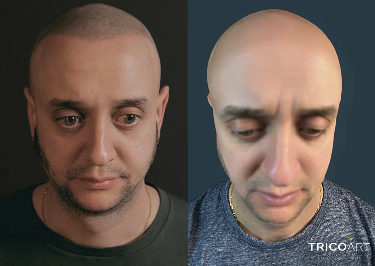 Tricopigmentazione: Il Futuro dei Metodi di Ricrescita Capelli