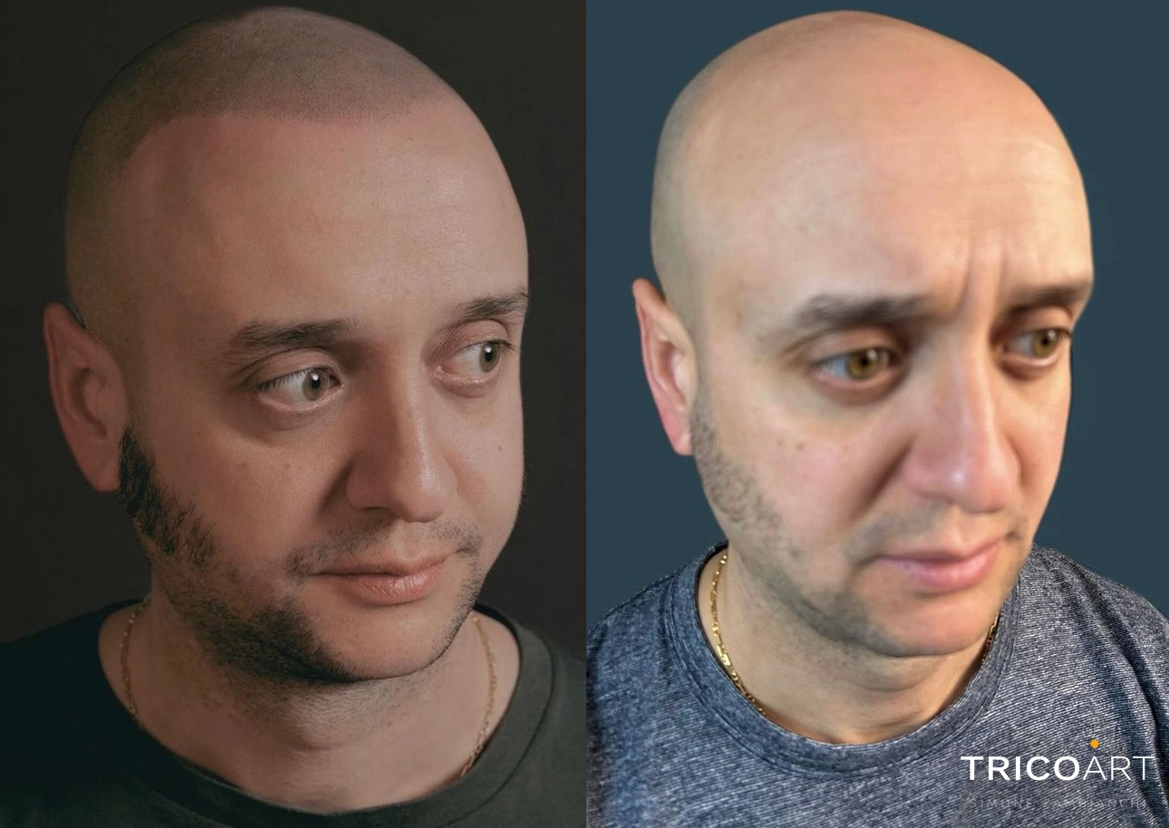 Affrontare l'Alopecia Arezzo: Scopri la Tricopigmentazione