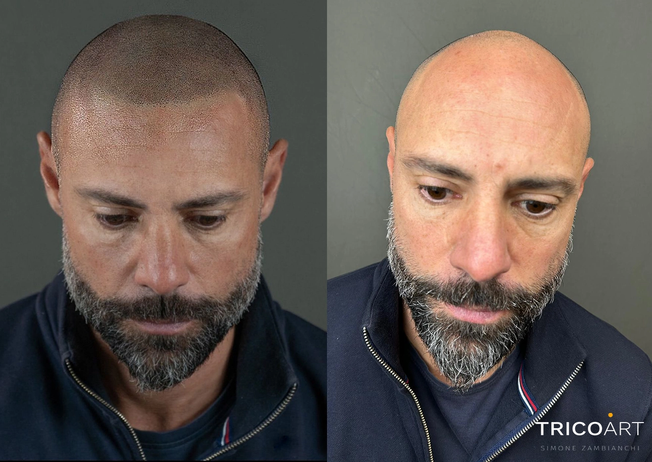 Trattamenti Efficaci per la Cura dell'Alopecia a Cremona