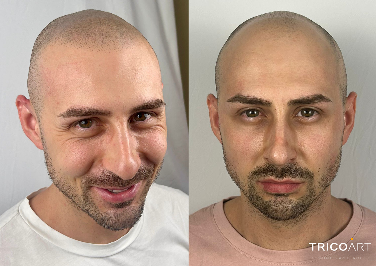 Risultato di tricopigmentazione TricoArt Modena 2