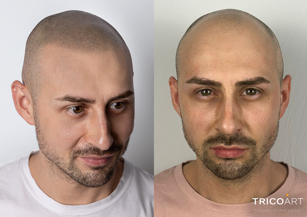 TRAPIANTO DI CAPELLI A PADOVA
