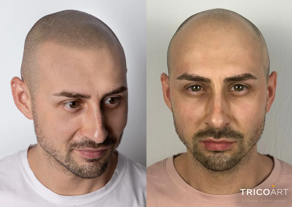 Trapianto di capelli a Padova