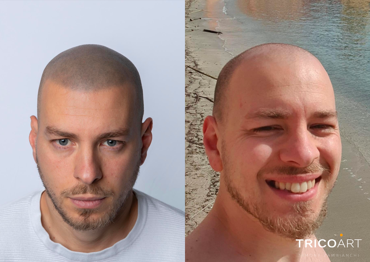 SOLUZIONE ALLA CADUTA DEI CAPELLI A BRESCIA