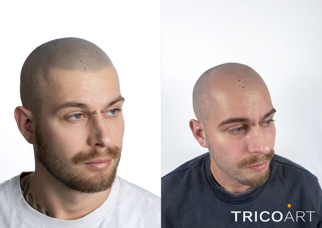 Trapianto di capelli a Genova