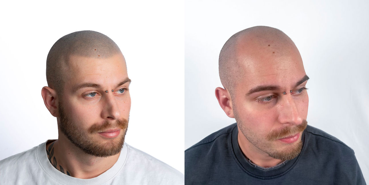 LA TRICOPIGMENTAZIONE COME ALTERNATIVA AL TRAPIANTO DI CAPELLI A GENOVA